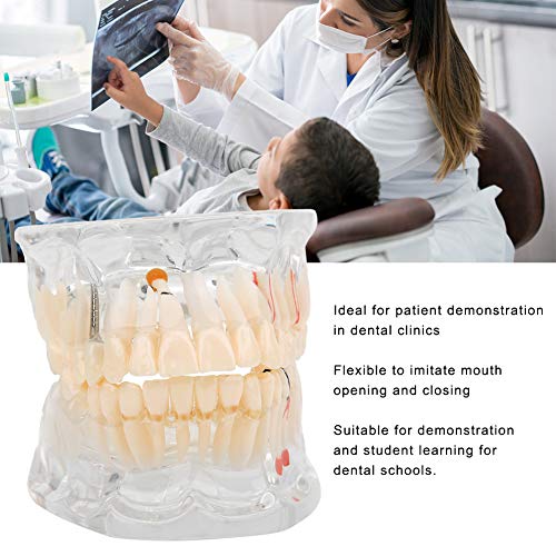 Diş Modeli-Patoloji Modeli ile Eksik Diş Diş Deneysel Araştırma Öğretim Ekipmanları, 6.9 oz, Şeffaf
